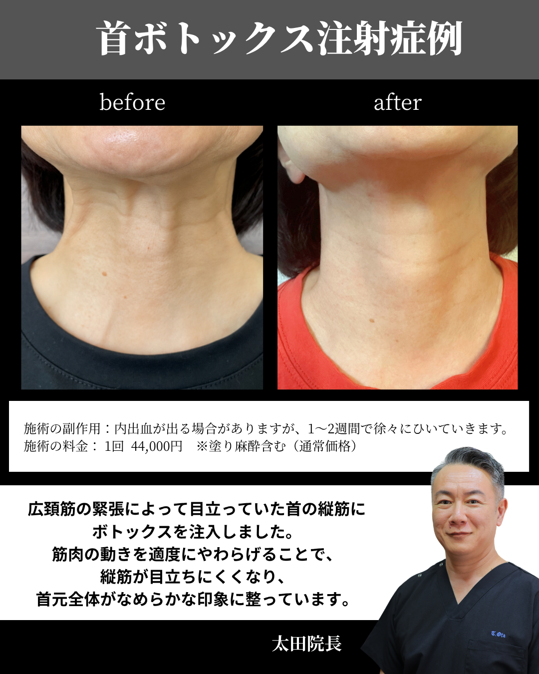 首ボトックスの症例写真
