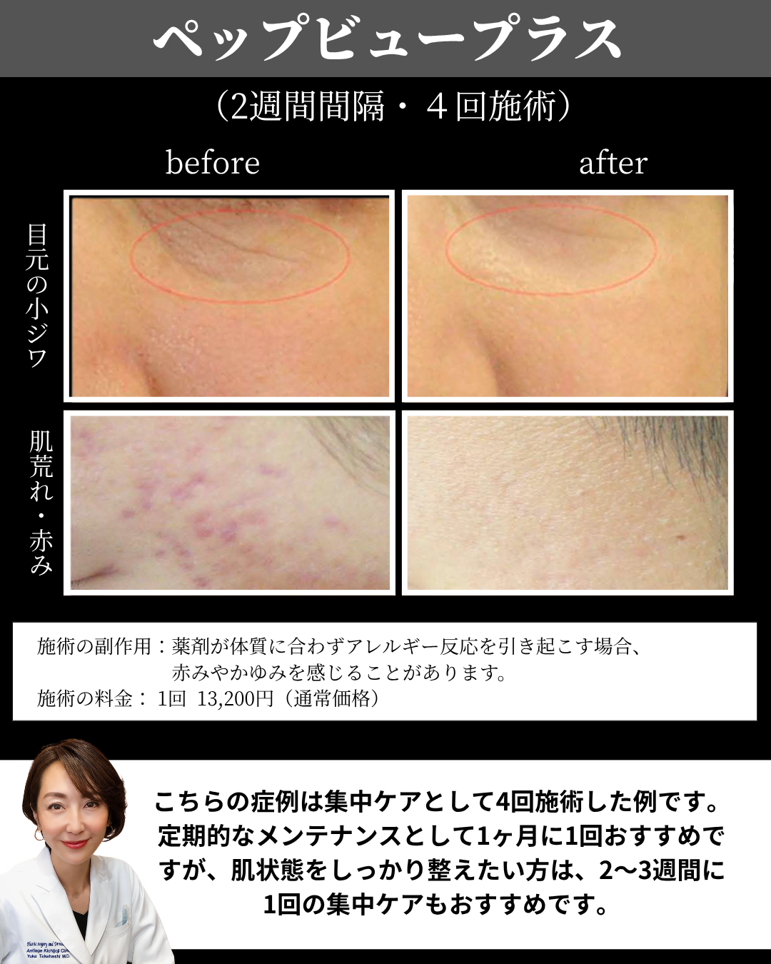 ケアシス ペップビュープラス導入の症例写真