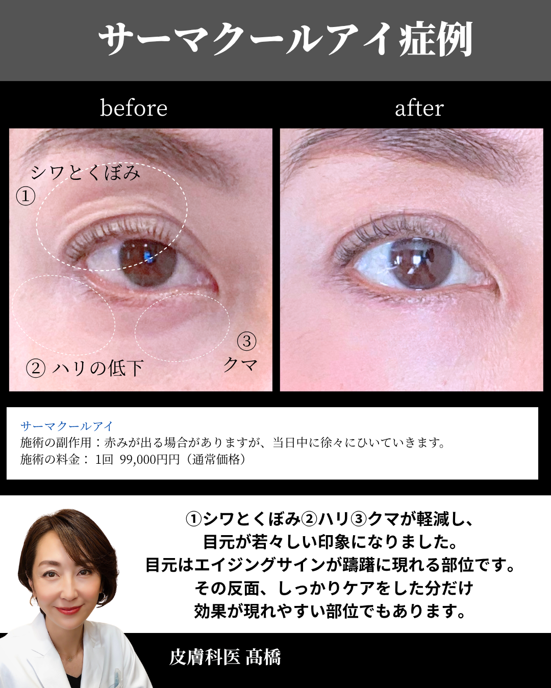サーマクールアイの症例写真