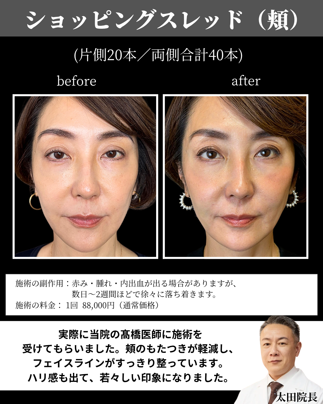 ショッピングスレッド頬40本の症例写真