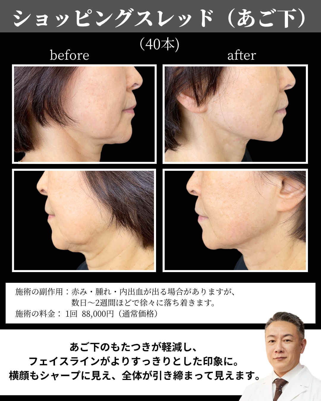 ショッピングスレッドあご下40本の症例写真