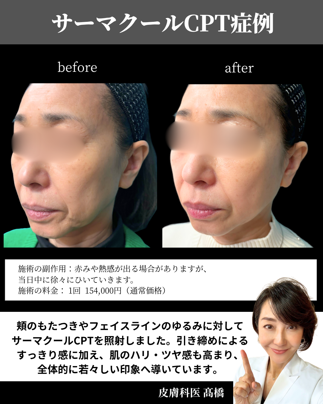 サーマクールCPTの症例写真