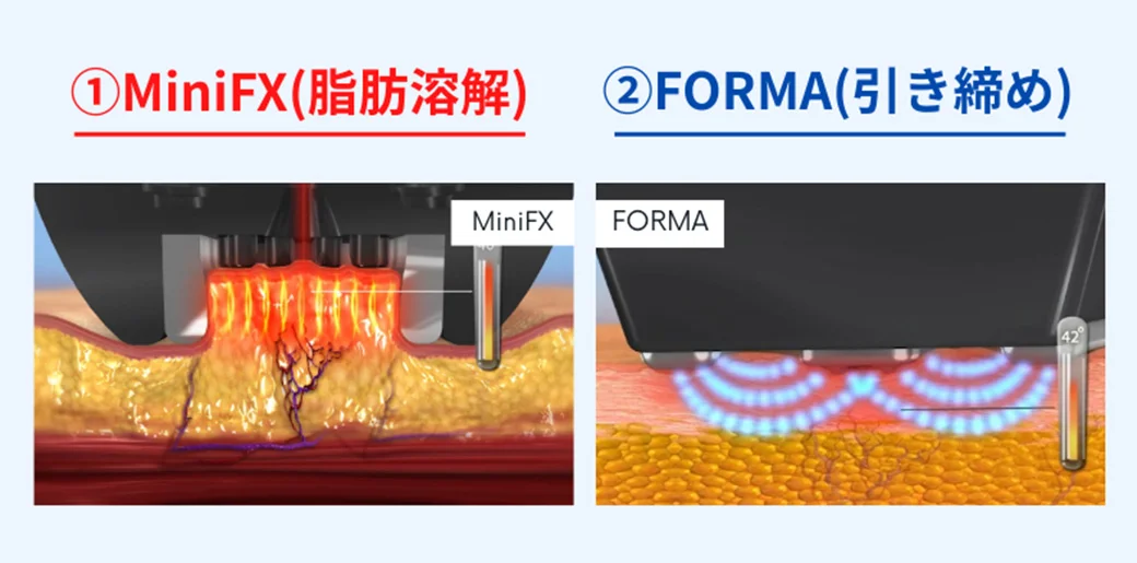 インモードリフトsaの説明