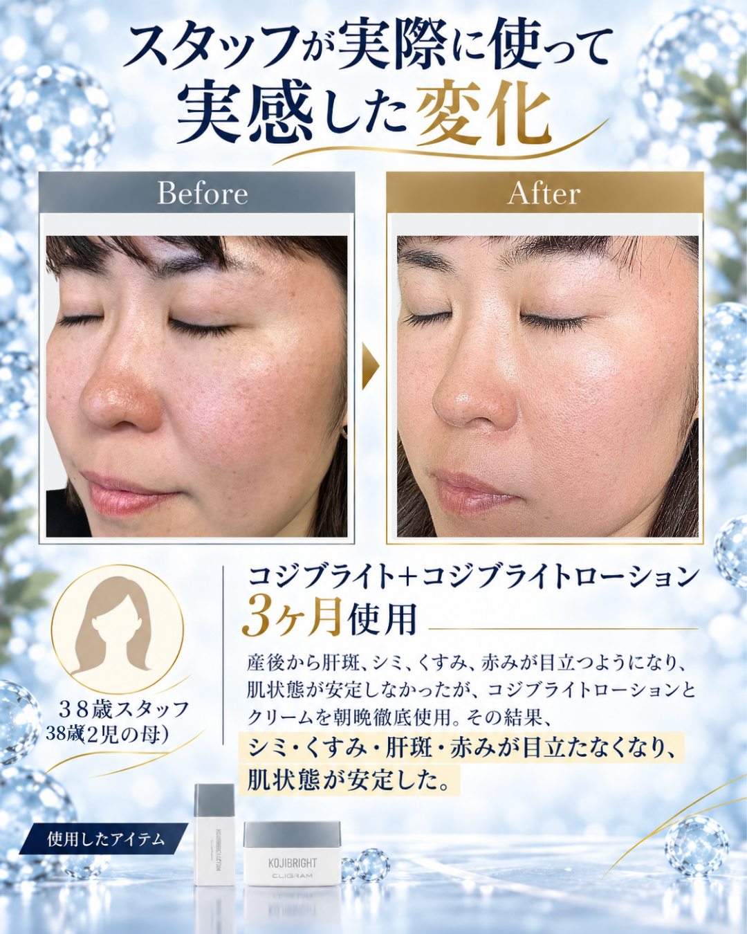 CLIGRAM コジブライトローション・コジブライトを使用したスタッフ症例